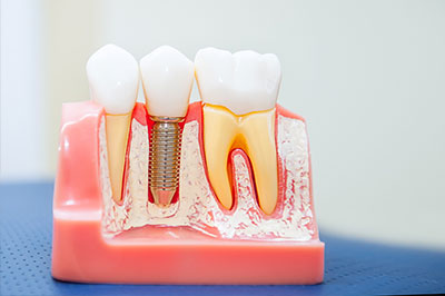 Dr. Wanda I. Salda  a | Dentures, Dental Bonding and Ceramic Crowns